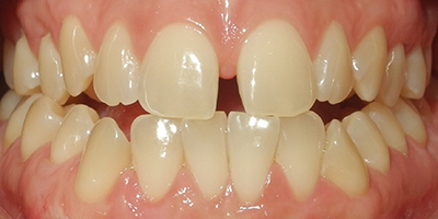 Ortodonzia e chirurgia prima e dopo